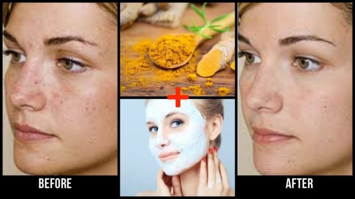 Turmeric Benefits For Skin at Annalisa Hanley blog Turmeric Benefits For Skin at Annalisa Hanley blog