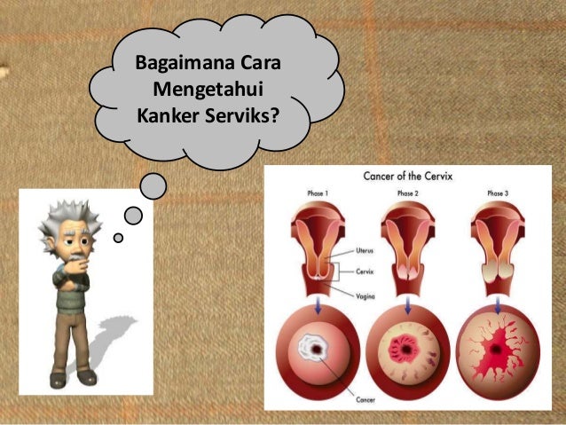 Tak Ingin Istri Kanker Serviks, Suami Harus Rela Puasa Sebulan